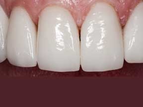 veneer-after-2